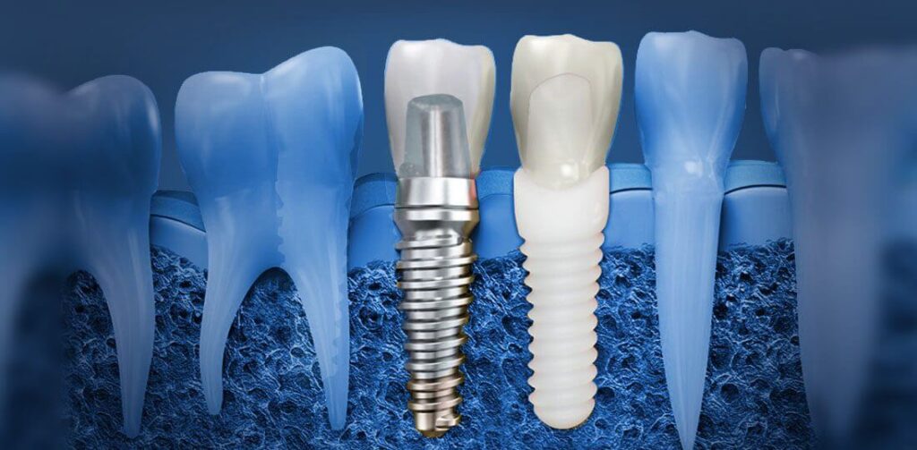 How to Get a Grant for Dental Implants
