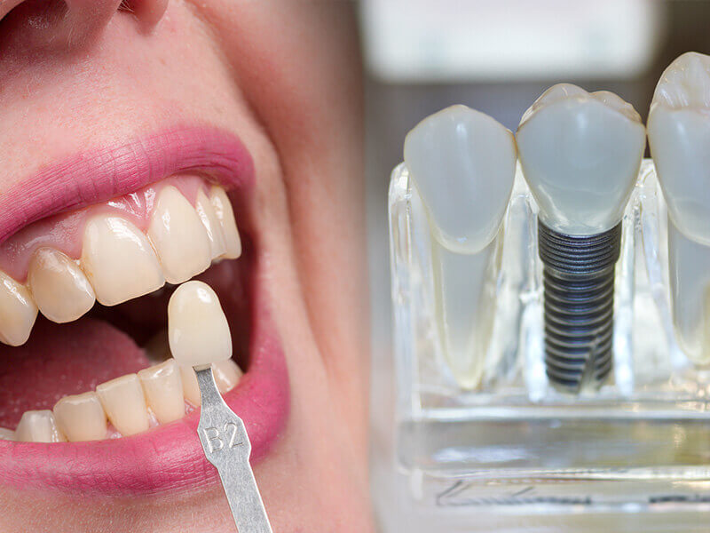 How To Get a Grant for Dental Implants – The Process